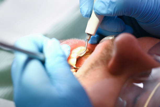 Best Emergency Wisdom Tooth Extraction in Youngsville, LA